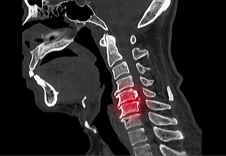 ossification-cervical-blog-img