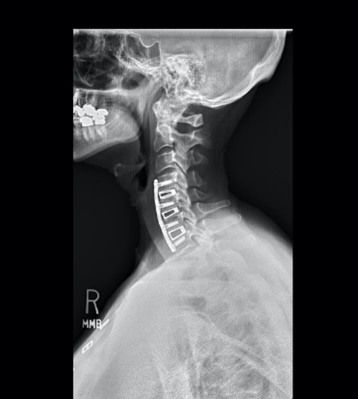 cervical kyphosis neck