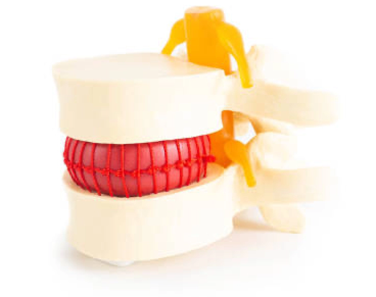 Degenerative Disc Disease | Wascher Spine Institute