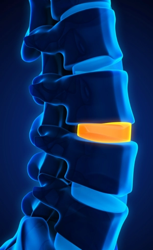 Degenerative Disc Disease | Wascher Spine Institute